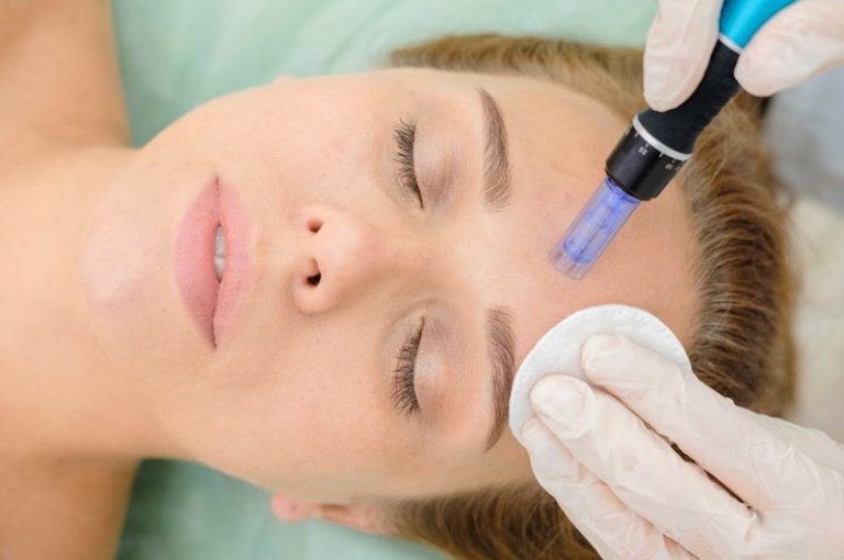 Micro-Needling-1000x658-1-768x510