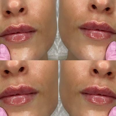 russian-lip-filler-essex russian-lip-filler-essex