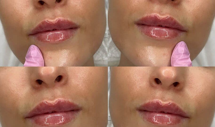 russian-lip-filler-essex