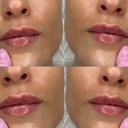 russian-lip-filler-essex